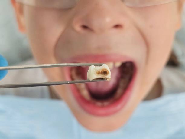 Best Emergency Treatment for Dental Infections or Abscesses in San Dimas, CA